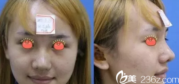 我在桂林華美做鼻綜合手術(shù)后7天 我在桂林華美做鼻綜合手術(shù)后7天