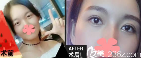 廈門臉博士賈洪仁雙眼皮7mm一年后照片