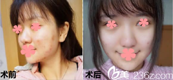 王珊珊祛痘案例及前后對(duì)比效果圖