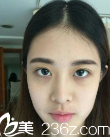 填充脂肪術前照片 填充脂肪術前照片