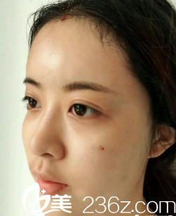 看我臉上的針眼