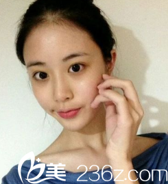 為了年底的相親，在威海做了自體脂肪填充全臉面部手術，大功告成了