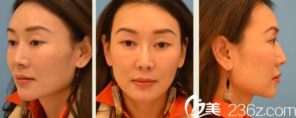 我想感謝他一輩子!Dr.spa醫(yī)院的鈴木芳郎為我做的面部埋線提升真的太棒了!