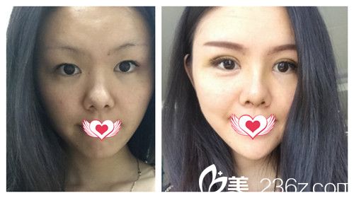 廊坊華康雙眼皮案例 廊坊華康雙眼皮案例