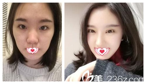 華康整形醫(yī)院做硅膠隆鼻前后對比 華康整形醫(yī)院做硅膠隆鼻前后對比