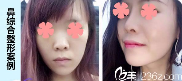 泉州歐菲胡利韜鼻綜合隆鼻一年后對(duì)比效果 泉州歐菲胡利韜鼻綜合隆鼻一年后對(duì)比效果