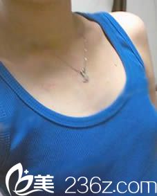 我在韓國一美知整形做假體隆胸術(shù)前照 我在韓國一美知整形做假體隆胸術(shù)前照