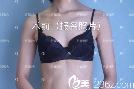 假體豐胸術(shù)前照片 假體豐胸術(shù)前照片
