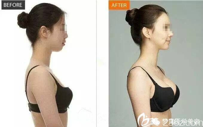 佛山夢(mèng)露游萬(wàn)福院長(zhǎng)隆胸前后對(duì)比圖