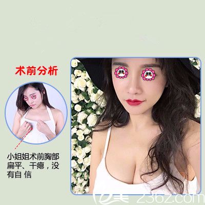 鄭州醫(yī)德佳整形醫(yī)院豐胸效果圖