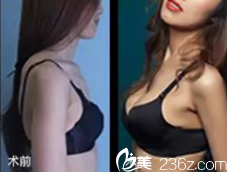 假體豐胸術(shù)前術(shù)后對(duì)比照片 假體豐胸術(shù)前術(shù)后對(duì)比照片