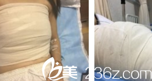 胸部修復(fù)術(shù)前照片 胸部修復(fù)術(shù)前照片