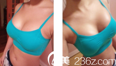 修復(fù)完成之后胸部的狀態(tài) 修復(fù)完成之后胸部的狀態(tài)