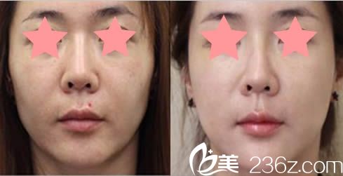瑞姿整形醫(yī)院面部提升案例對比圖