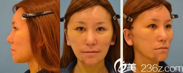 鈴木芳郎面部大拉皮手術(shù)經(jīng)過了一周