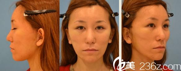 鈴木芳郎面部大拉皮手術(shù)經(jīng)過了兩周后