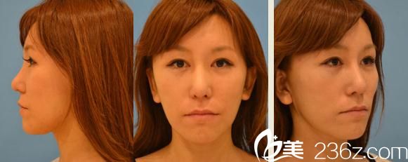 鈴木芳郎面部大拉皮手術(shù)過去一個月