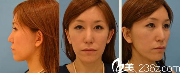 ?面診了Dr.spa醫(yī)院的鈴木芳郎醫(yī)生，他做的面部大拉皮手術(shù)從此讓我笑靨動(dòng)人!