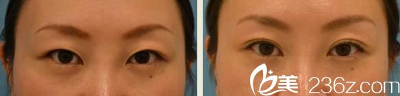 Dr.Sa式的埋線(xiàn)雙眼皮前后對(duì)比