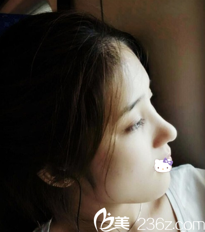 綿陽朗睿劉鋒假體+耳軟骨綜合隆鼻術(shù)后側(cè)面照