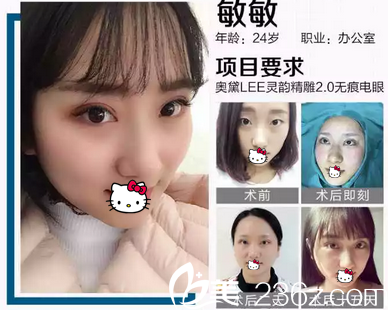 雙眼皮案例 雙眼皮案例