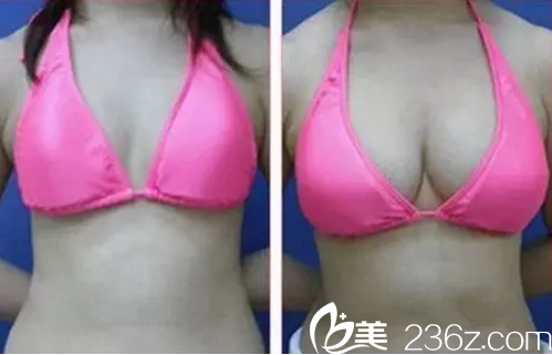 曹家整形隆胸前后對(duì)比