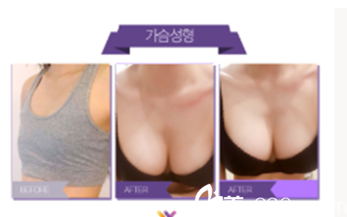 韓國(guó)WESHE整形外科醫(yī)院胸部整形