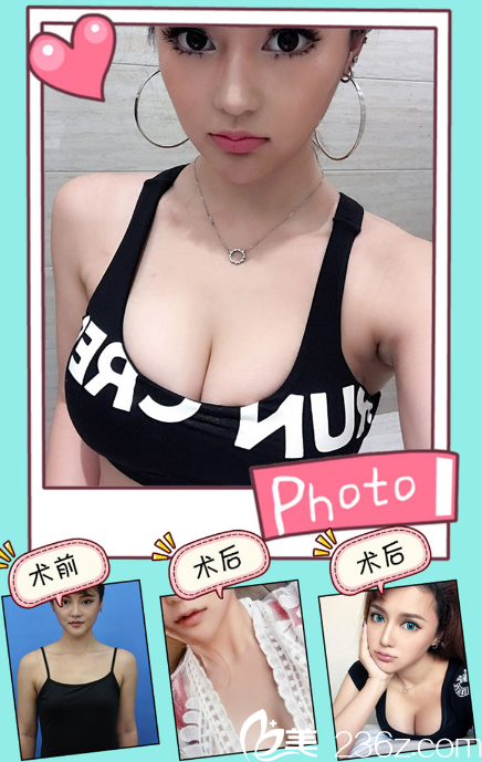 佛山美萊孫婧隆胸案例 佛山美萊孫婧隆胸案例