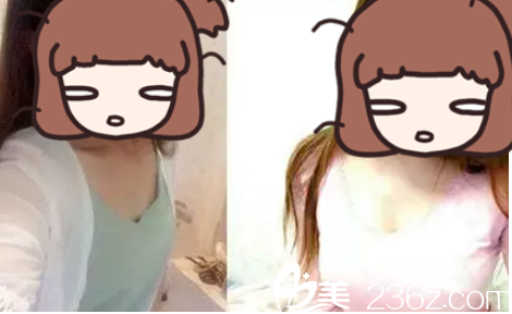 劉宏偉醫(yī)生隆胸效果圖