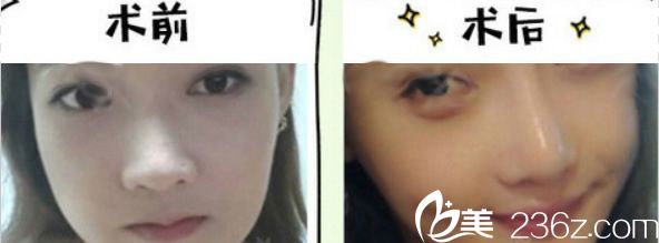 比華利鼻綜合隆鼻案例圖