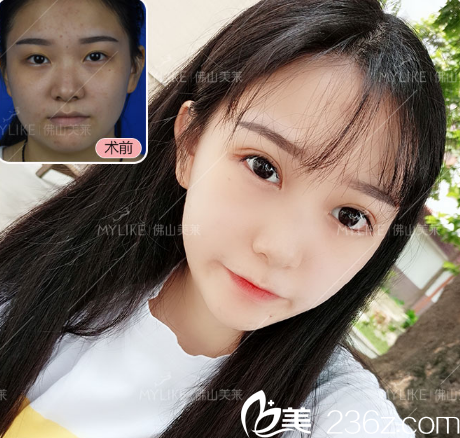 佛山美萊開業(yè)優(yōu)惠整形價(jià)格表 張春光雙眼皮8000元,王燕隆鼻12800元附案例