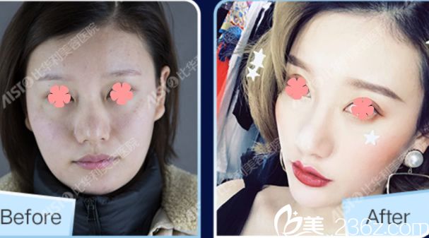 比華利張敏自體脂肪面部填充案例圖