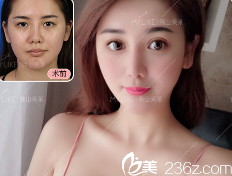 佛山美萊劉永揚雙眼皮案例對比圖 佛山美萊劉永揚雙眼皮案例對比圖