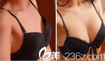 北京美萊整形才杰假體隆胸案例前后對比圖 北京美萊整形才杰假體隆胸案例前后對比圖
