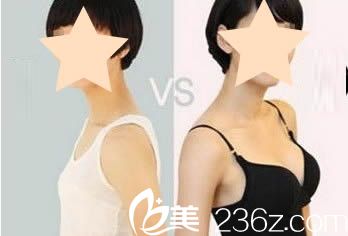 武漢美立方整形胡江偉院長(zhǎng)自體脂肪隆胸效果圖
