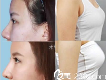 東莞締美整形趙可醫(yī)師假體隆鼻和假體隆胸效果圖 東莞締美整形趙可醫(yī)師假體隆鼻和假體隆胸效果圖