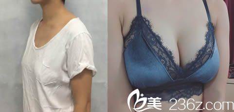 合肥華美整形趙輯院長假體隆胸案例效果對比圖 合肥華美整形趙輯院長假體隆胸案例效果對比圖