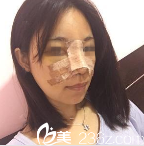 在南寧韓成做鼻綜合手術(shù)后第2天 在南寧韓成做鼻綜合手術(shù)后第2天