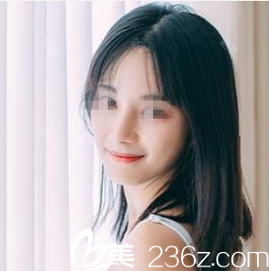 在南寧韓成做鼻綜合手術(shù)后1個月 在南寧韓成做鼻綜合手術(shù)后1個月