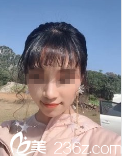 朋友推薦我來(lái)南寧韓成做膨體+肋軟骨隆鼻術(shù)后2個(gè)月鼻子就像天生的一樣自然