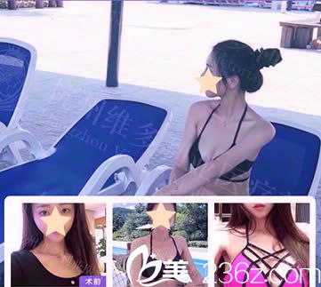 杭州維多利亞假體隆胸效果對比圖