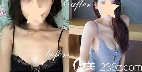 廣州軍美整形王世虎自體脂肪隆胸案例圖 廣州軍美整形王世虎自體脂肪隆胸案例圖