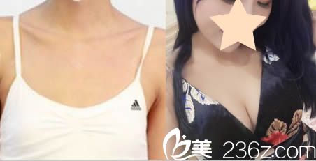 東莞水立方李志剛主任假體隆胸案例效果圖 東莞水立方李志剛主任假體隆胸案例效果圖