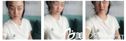 術(shù)前胸部扁平 術(shù)前胸部扁平