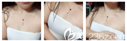 在無錫坤如瑪麗隆胸前平胸