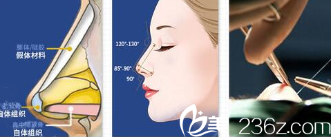 南寧韓成肋軟骨隆鼻