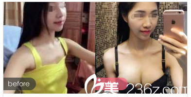 術(shù)后一周拆線假體隆胸前后對比 術(shù)后一周拆線假體隆胸前后對比