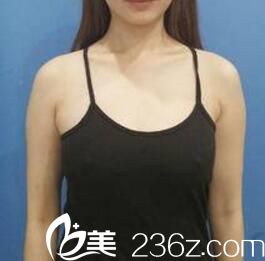 做假體隆胸術(shù)前照 做假體隆胸術(shù)前照