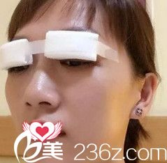 張曉光醫(yī)生為我剛做完雙眼皮修復(fù)后有點腫脹 張曉光醫(yī)生為我剛做完雙眼皮修復(fù)后有點腫脹