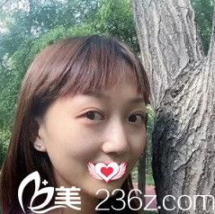 初次做雙眼皮失敗后來到邯鄲華美通過埋線雙眼皮修復(fù)術(shù)重現(xiàn)芭比大眼